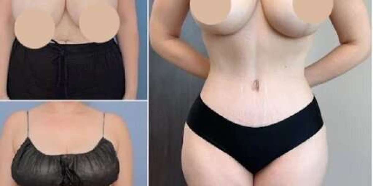 Best Tummy Tuck Surgeons in Dubai for Refined Body Proportions