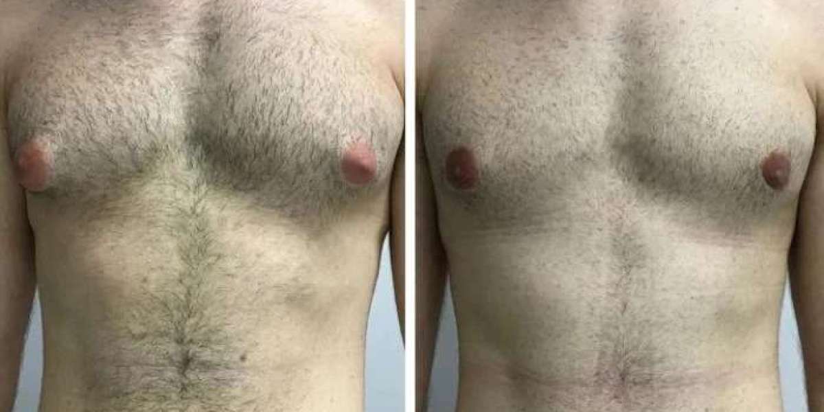 How the Best Gynecomastia Surgeon in dubai Assesses Areola Shape