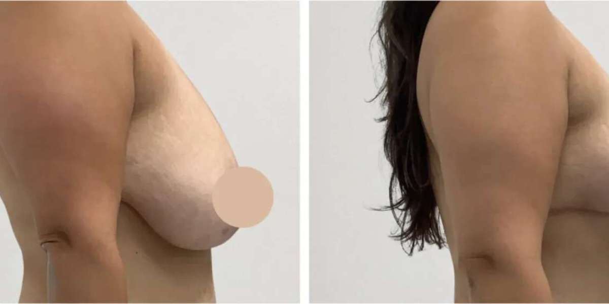 Best Breast Lift Surgeons in Dubai for Precise Breast Reshaping
