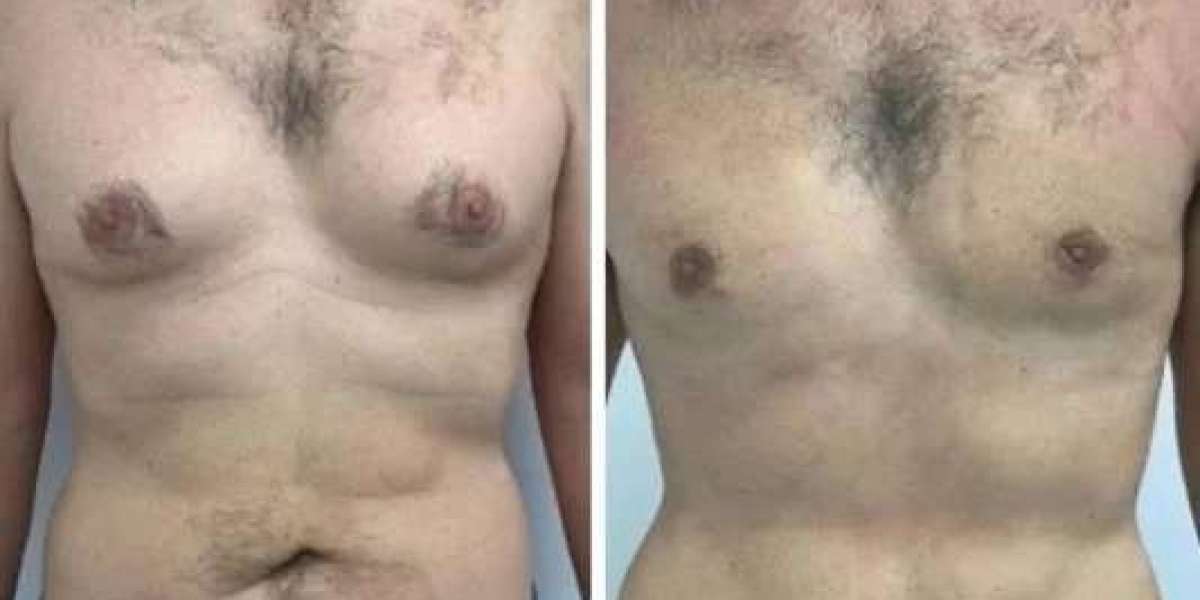 Best Gynecomastia Surgeons in Dubai: Understanding Comprehensive Care