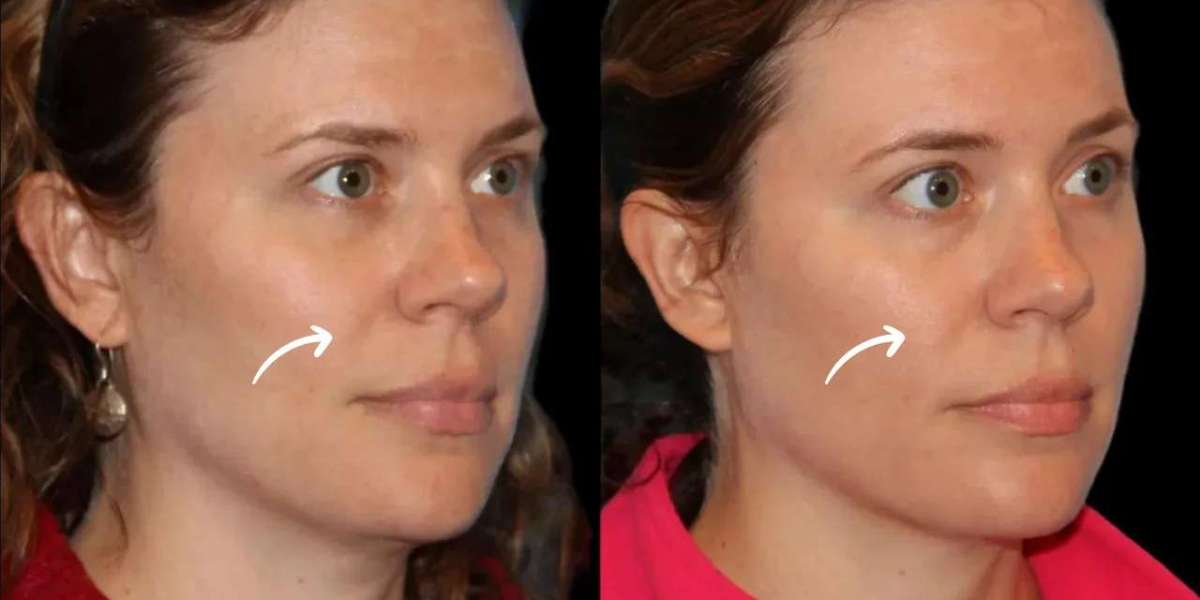 Best Aesthetic Clinics in Dubai: Sculptra Fillers and Patient Decision Factors