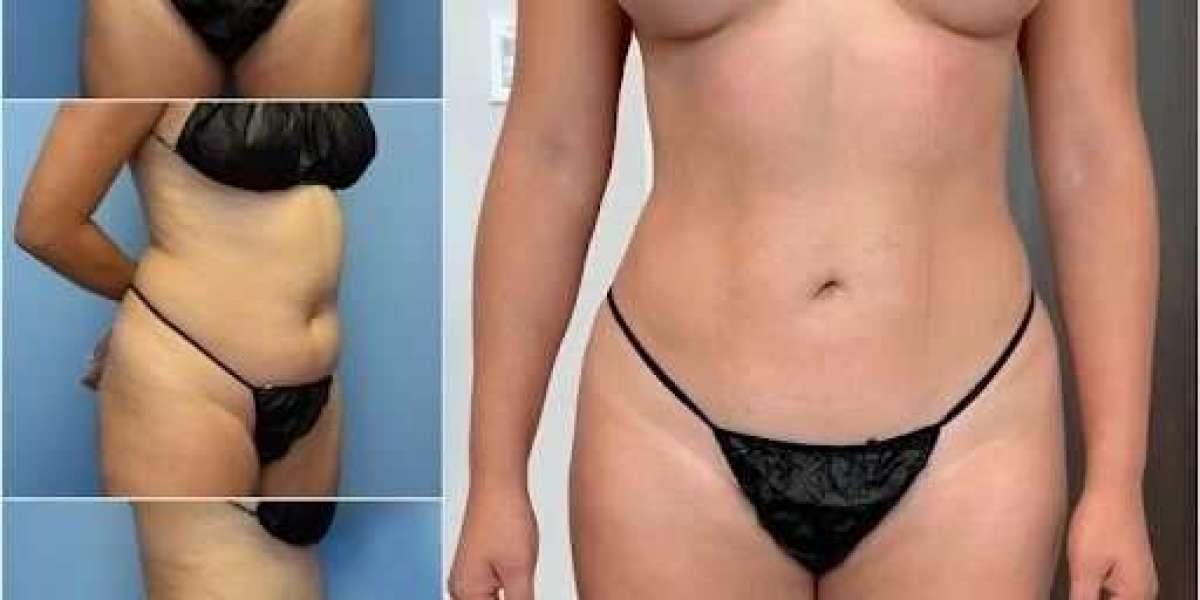 Best Body Contouring Surgeons in Dubai: More Sculpted and Confident Appearance
